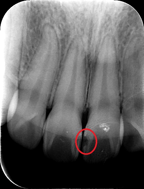 Services in Dentistry Part 5: Dental X-rays – Dr. Bridget Han's Dental Blog